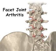 ostheoarthritis video
